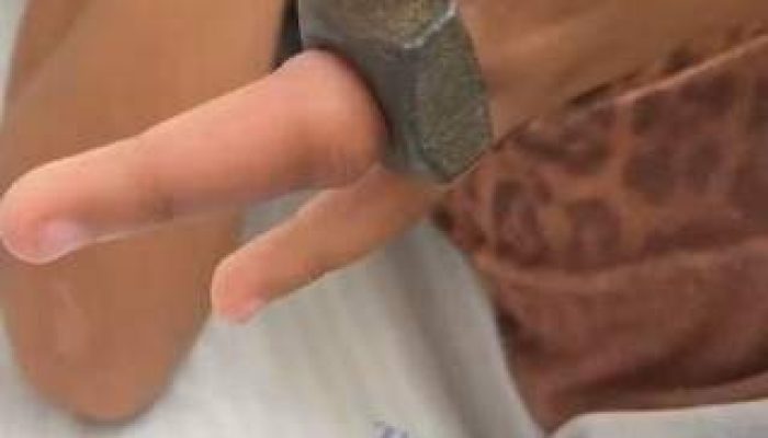 Uma criança de 7 anos precisou da ajuda do Corpo de Bombeiros para retirar uma porca metálica que ficou presa…